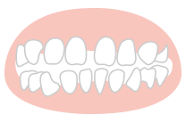 すきっ歯の矯正
