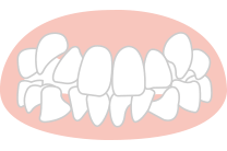 八重歯・叢生（そうせい・デコボコ）の矯正
