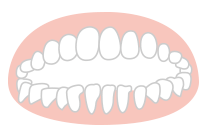 開咬の矯正