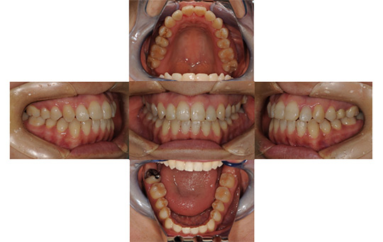 叢生　非抜歯ケース 治療後