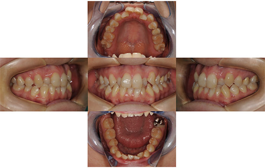 叢生　非抜歯ケース 治療前