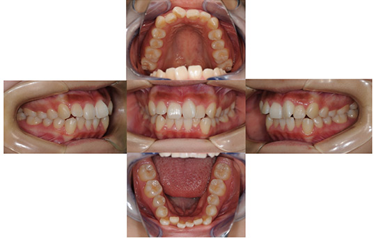 叢生　抜歯ケース　治療前