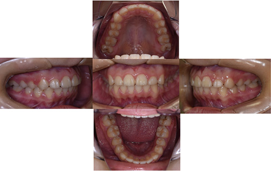 前突　非抜歯ケース　治療後
