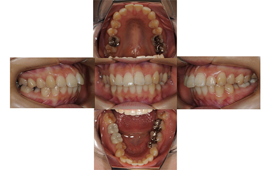 前突　抜歯ケース　治療前