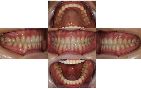 すきっ歯　非抜歯ケース 治療後