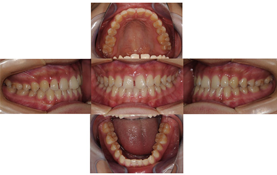すきっ歯　非抜歯ケース 治療前