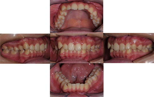 過蓋咬合　非抜歯ケース 治療前