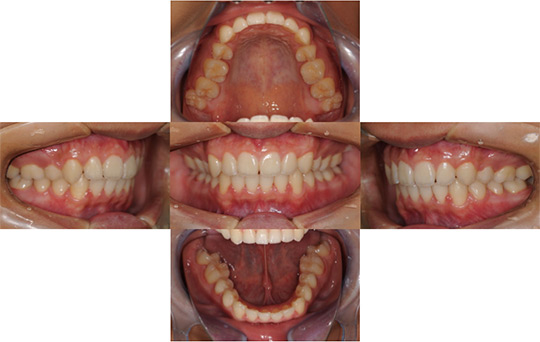 過蓋咬合　抜歯ケース　治療後