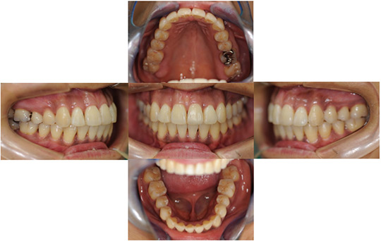開咬　非抜歯ケース 治療後