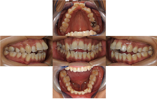 開咬　非抜歯ケース 治療前