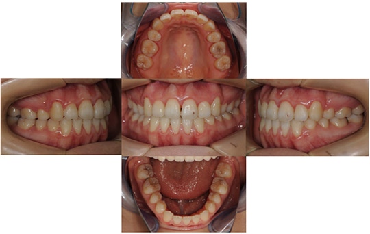 開咬　抜歯ケース　治療後