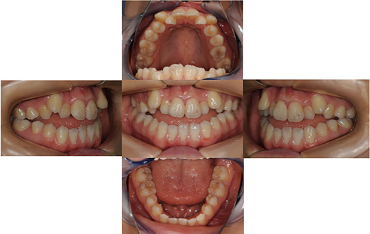 開咬　抜歯ケース　治療前