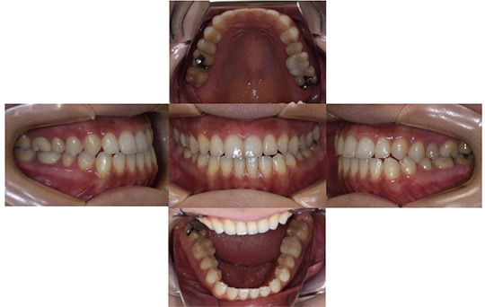 受け口（反対咬合） 非抜歯ケース　治療後