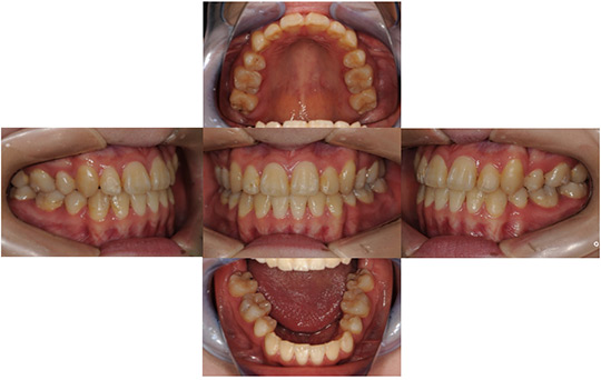 受け口（反対咬合）　抜歯ケース　治療後