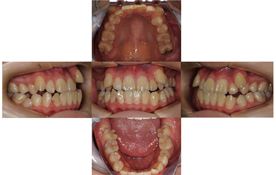 受け口（反対咬合）　抜歯ケース　治療前